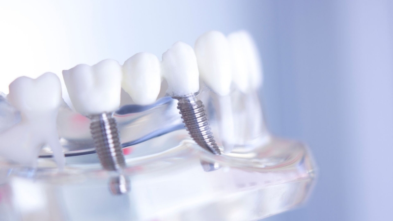 Quy trình trồng răng implant All on 4 thường trải qua nhiều giai đoạn