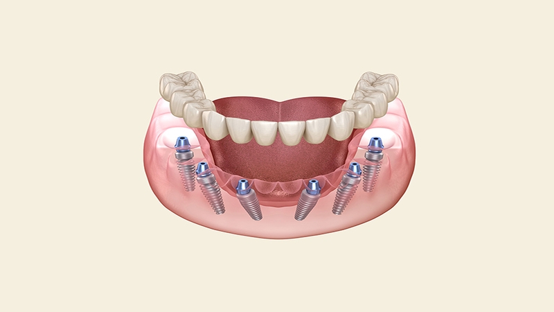 Trồng răng implant all on 6 có nên hay không? 1