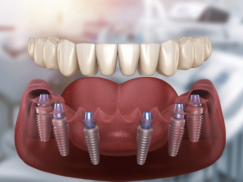 Trồng răng implant all on 6 có nên hay không? 2
