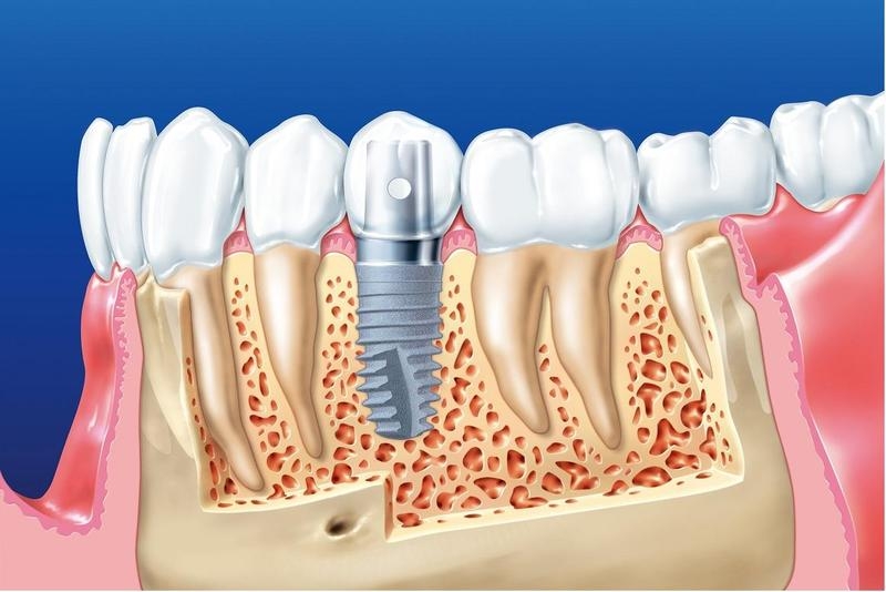 Trồng răng implant có chụp MRI được không?-1