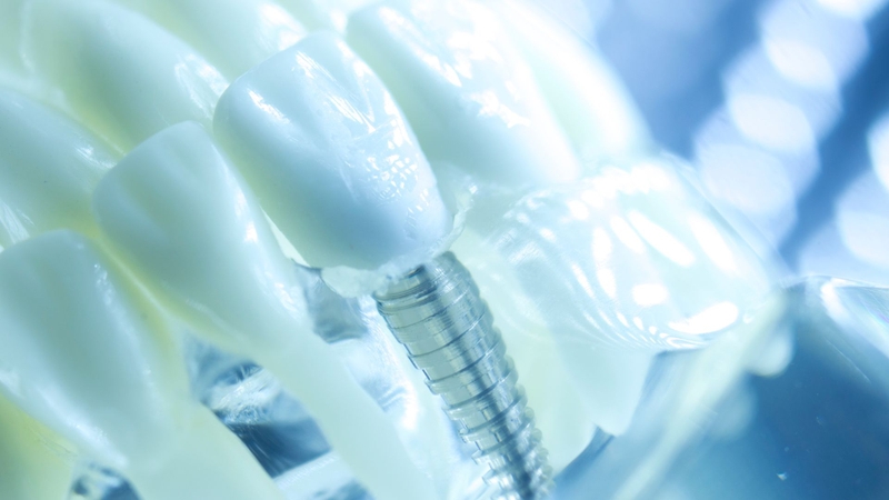 Trồng răng Implant có đau không? Giải đáp từ chuyên gia 3