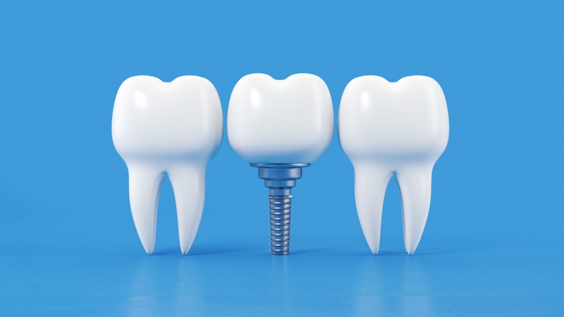 Trồng răng Implant giá bao nhiêu? Cập nhật chi phí và các yếu tố ảnh hưởng mới nhất 3