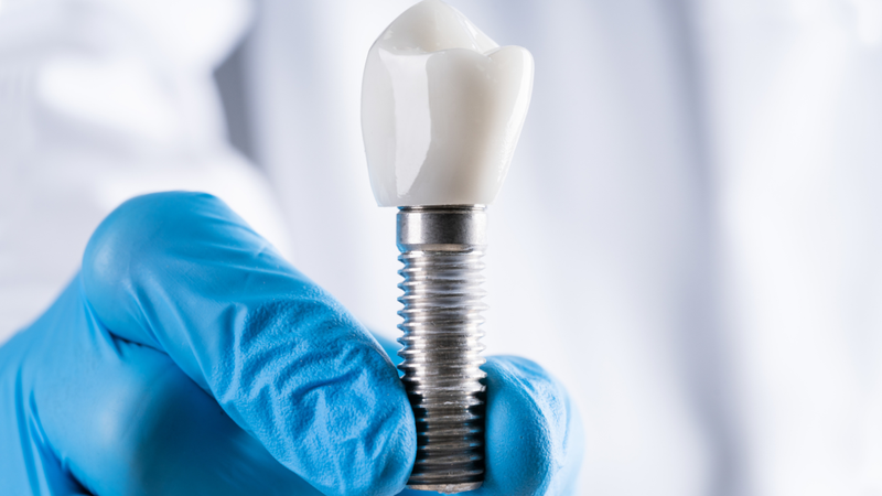 Người có thói quen nghiến răng nên cân nhắc khi chọn trồng răng Implant