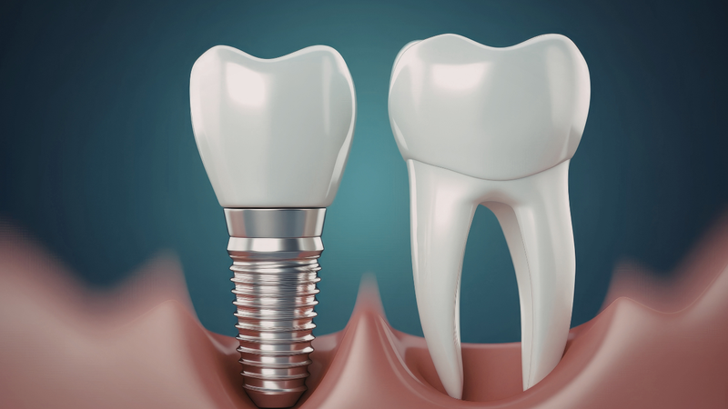 Trồng răng Implant thực hiện cấy một trụ nhân tạo vào xương hàm để đóng vai trò như chân răng thật