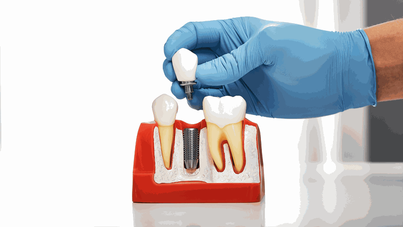 Trồng răng sứ giá bao nhiêu 1 chiếc 2