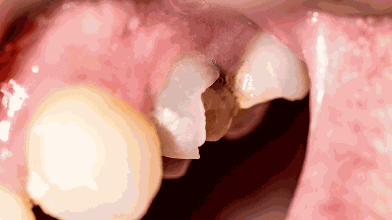 Trồng răng sứ giá bao nhiêu 1 chiếc 4