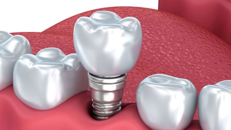 Trồng răng sứ vĩnh viễn giá bao nhiêu? Có lưu ý gì khi thực hiện? 1