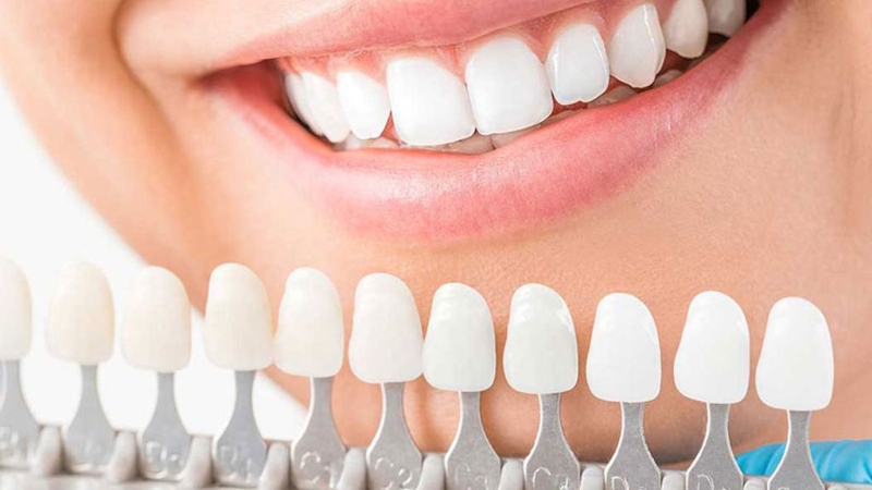 Trồng răng sứ vĩnh viễn giá bao nhiêu? Có lưu ý gì khi thực hiện?  2