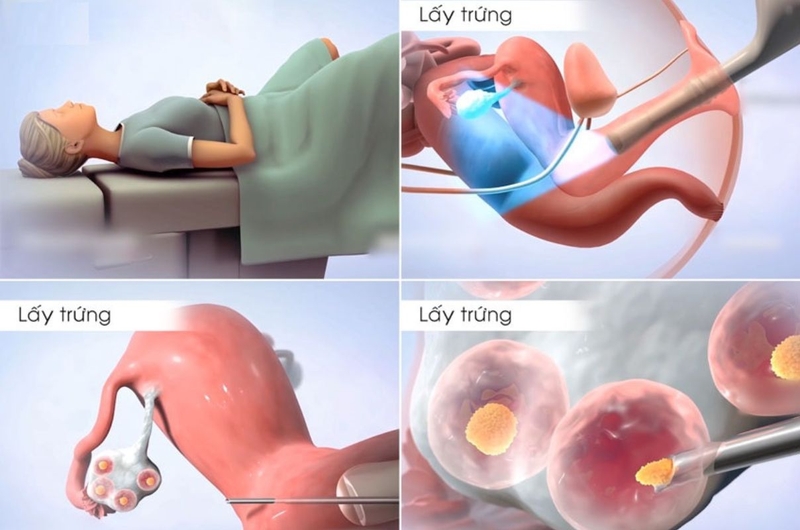 Trữ đông noãn là gì? Quy trình và chi phí thực hiện 3