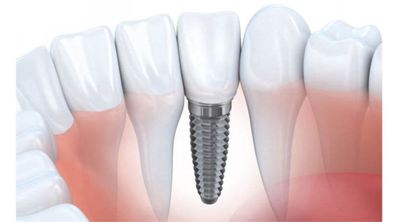 Trụ Implant Biotem có nguồn gốc từ đâu? Cấu tạo như thế nào? 1