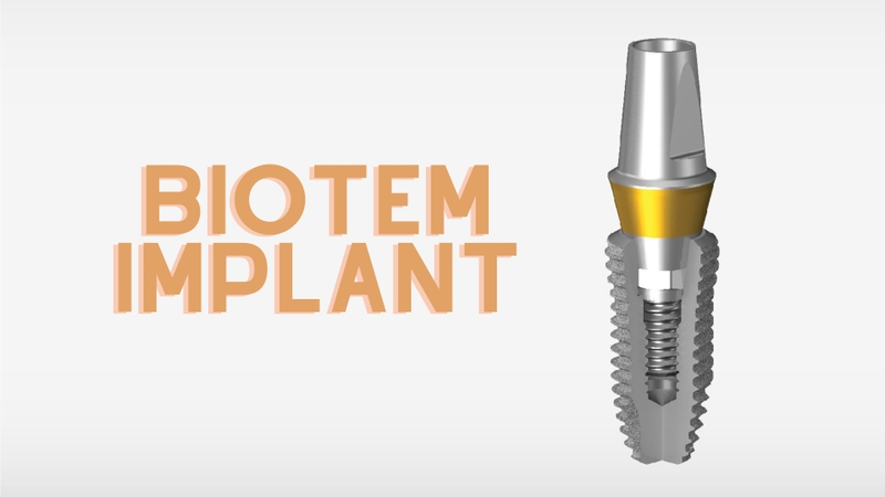 Trụ răng Biotem Implant và những điều cần biết 1