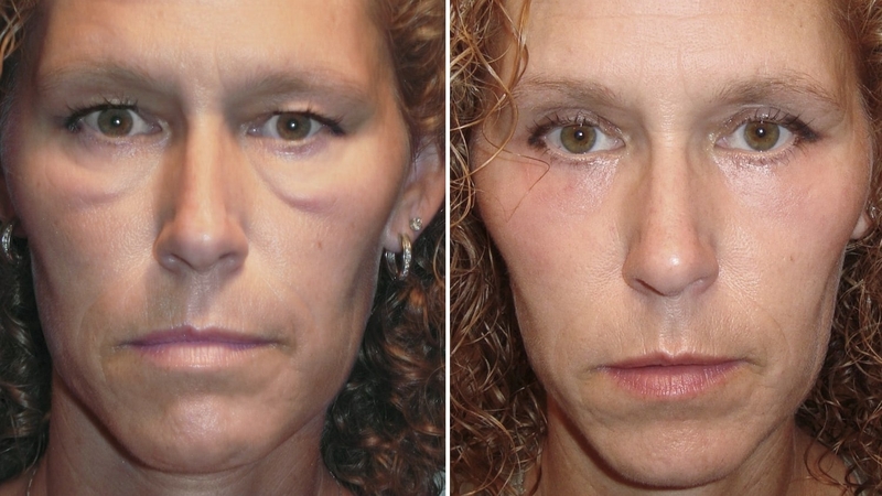 trung-ma-malar-mound-la-gi 1