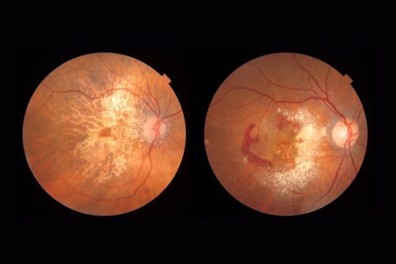 Trước khi mổ mắt có được ăn không? Một số bệnh về mắt cần phẫu thuật 2