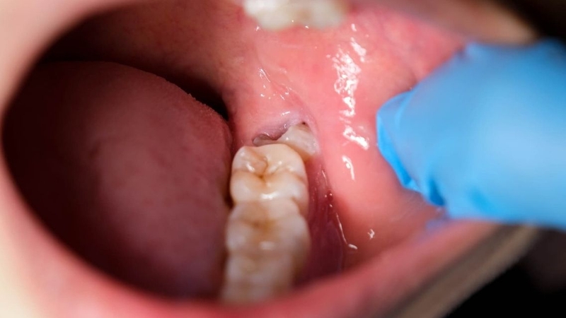Trước khi nhổ răng khôn nên làm gì để đảm bảo an toàn?