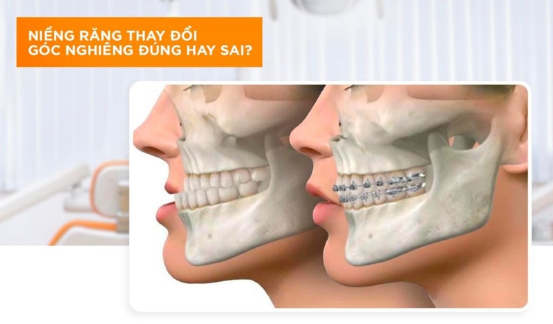 Trước và sau niềng răng có những thay đổi tích cực như thế nào? 2