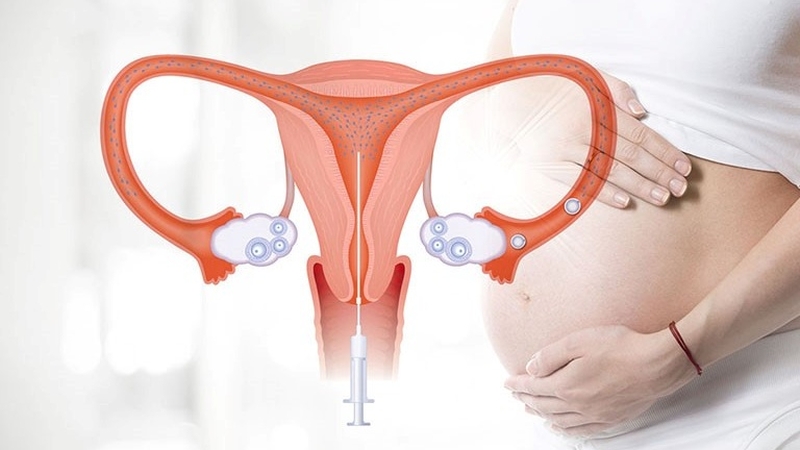 Thụ tinh nhân tạo là giải pháp hàng đầu cho những người vô sinh, hiếm muộn