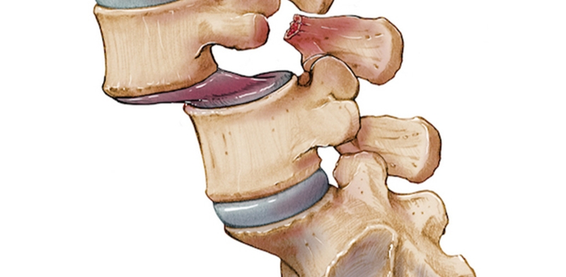 Trượt đốt sống ra trước (L4,L5) và những điều cần biết 1