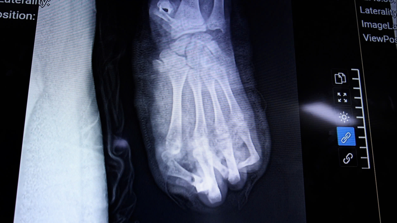 Bàn tay trái của nam thiếu niên bị dập nát nghiêm trọng do pháo nổ