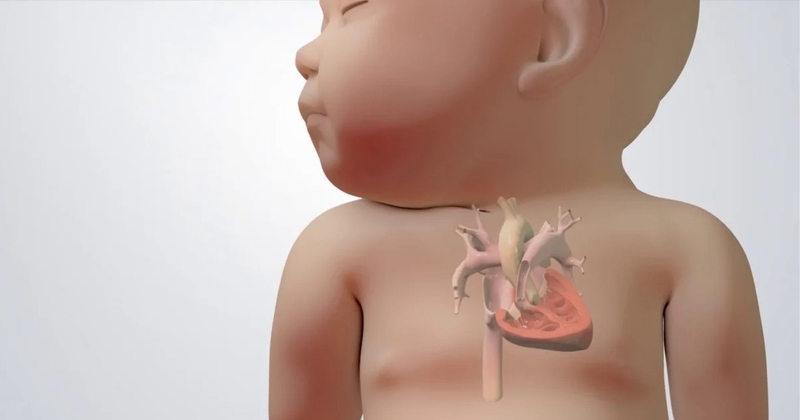 Tứ chứng Fallot là gì? Dấu hiệu nhận biết và cách điều trị 4