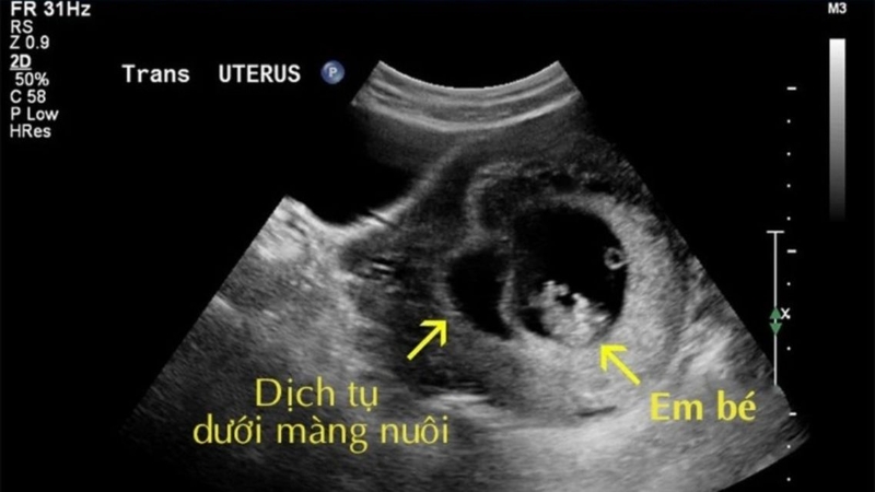 Tụ dịch màng nuôi bao lâu thì khỏi​&nbsp;là thông tin nhiều người muốn biết