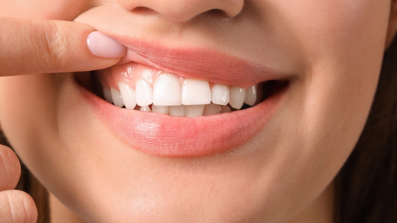 Men răng bị xói mòn nhanh chóng do acid ăn mòn lớp bảo vệ của răng