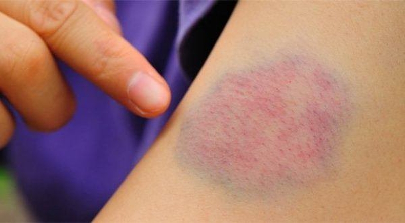 Tụ máu dưới da nguyên nhân do đâu? 1