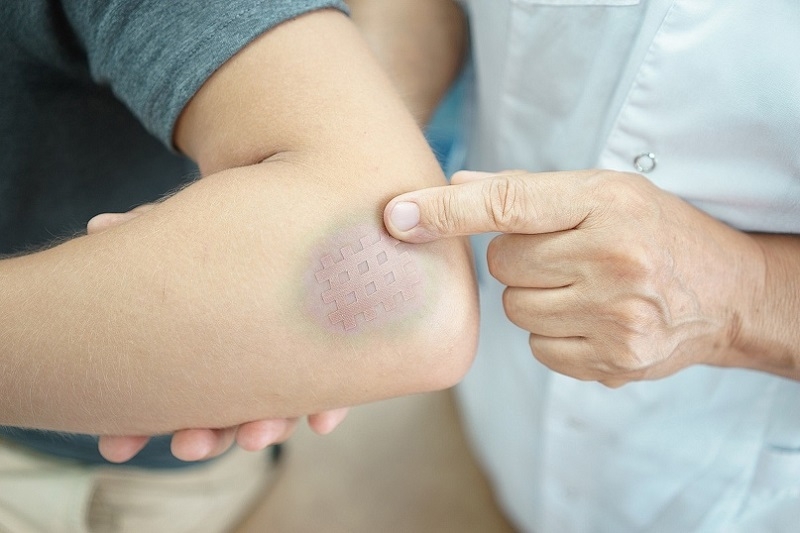 Tụ máu dưới da nguyên nhân do đâu? 2