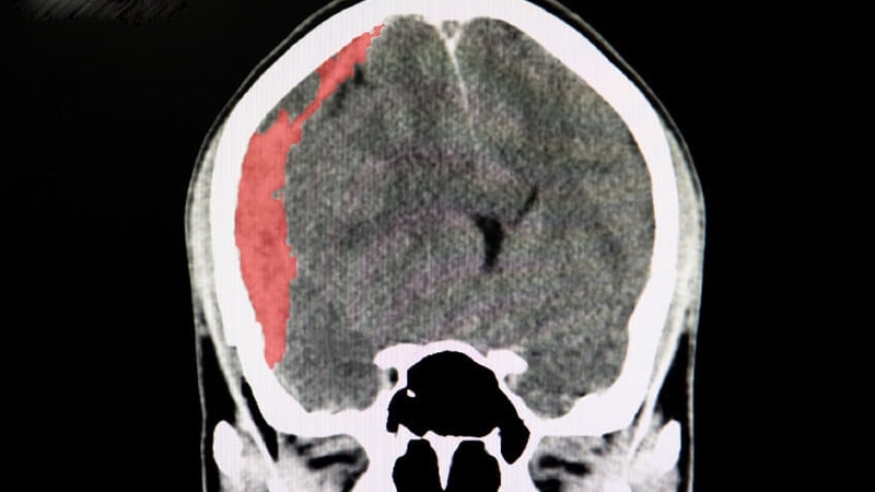 Tụ máu não sống được bao lâu? 1