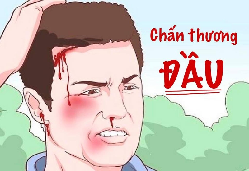 Tụ máu ngoài màng cứng: Nguyên nhân, triệu chứng, chẩn đoán và điều trị 1