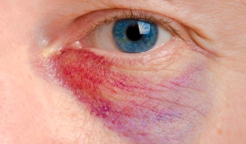 Tự nhiên bị bầm tím ở mắt là do đâu và cách khắc phục 1
