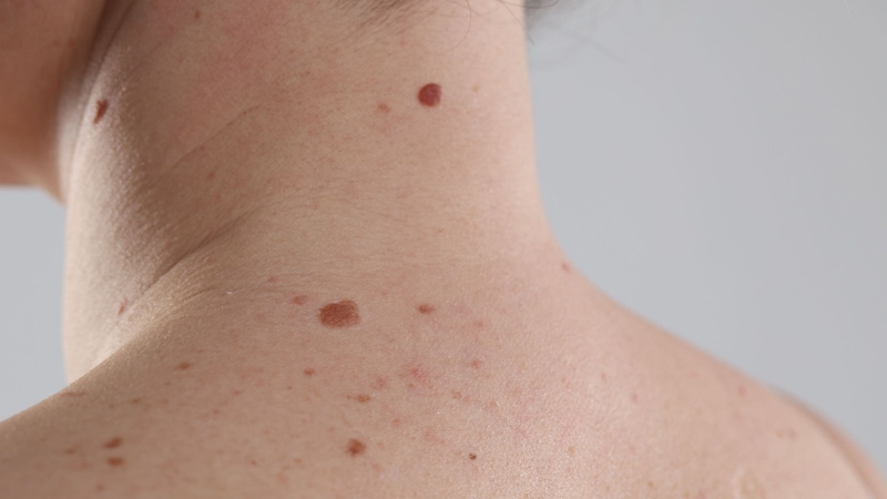 Nốt ruồi hình thành khi các tế bào sắc tố trong da tập trung thành cụm thay vì phân bố đồng đều