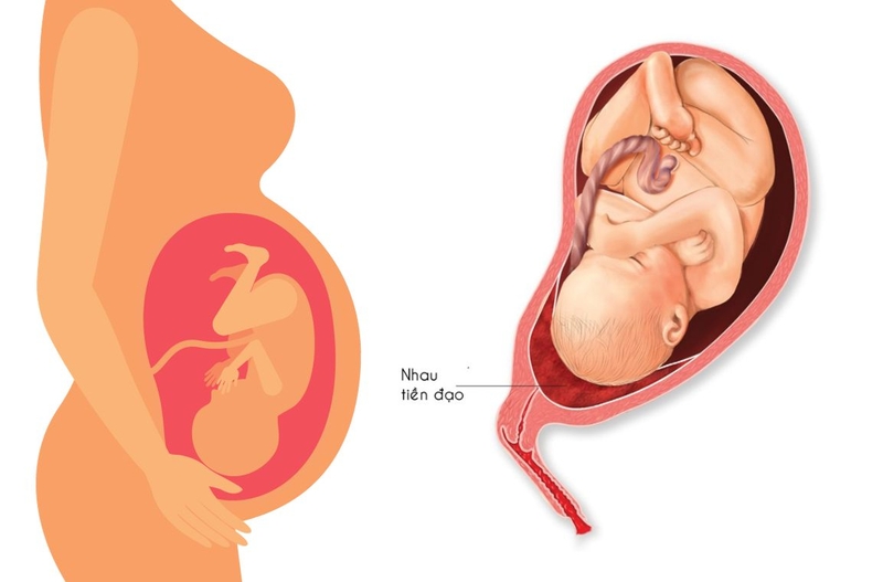 Gợi ý mẹ bầu tư thế nằm khi bị nhau tiền đạo 2