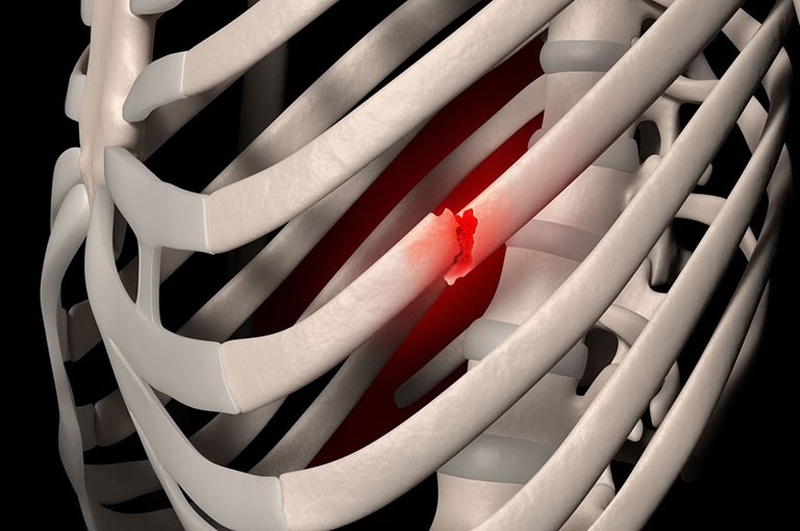 Hướng dẫn tư thế ngủ khi bị gãy xương sườn đúng nhất 1