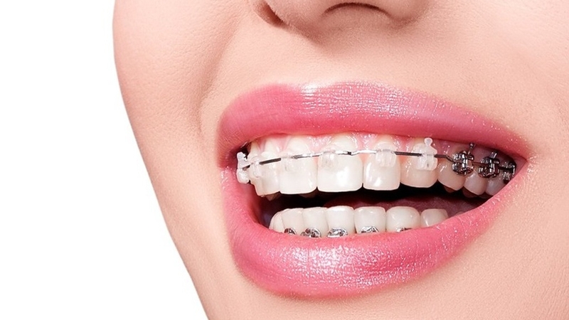 Tư thế ngủ khi niềng răng: Những lợi ích, sai lầm và lưu ý bạn cần biết 3