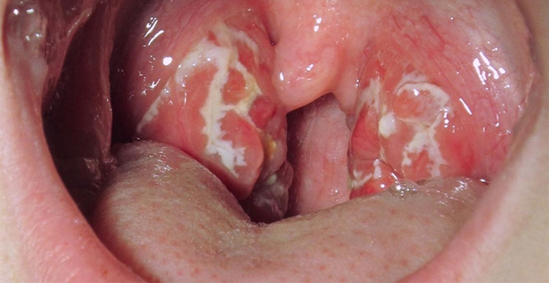 Tư vấn: Bị nấm họng kiêng ăn gì cho nhanh khỏi 1