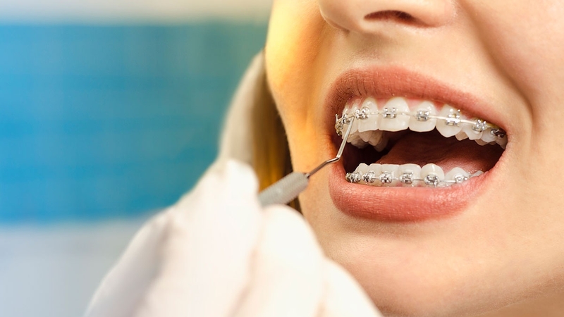 Tư vấn: Niềng răng bao lâu tái khám 2