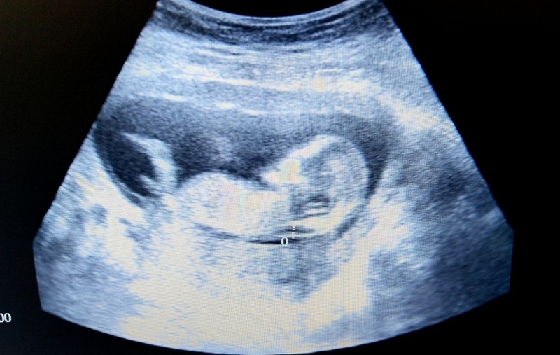 Tư vấn sức khỏe sinh sản: Độ mờ da gáy 1.6 mm có bình thường không? 2