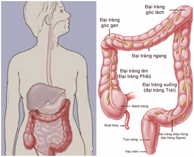 Từ viêm đại tràng đến ung thư 1