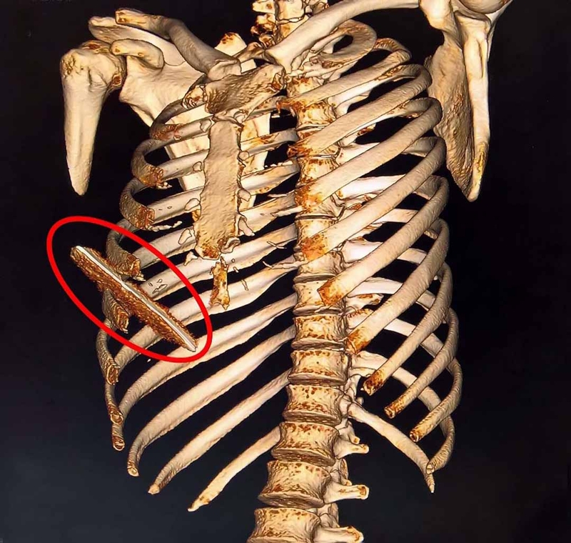 Tức ngực khi hít sâu là dấu hiệu của bệnh lý nguy hiểm nào? 2