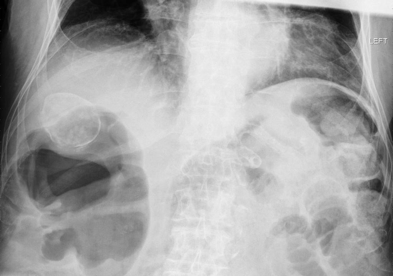 Túi mật sứ: Triệu chứng nhận biết, nguyên nhân, cách chẩn đoán và điều trị 1