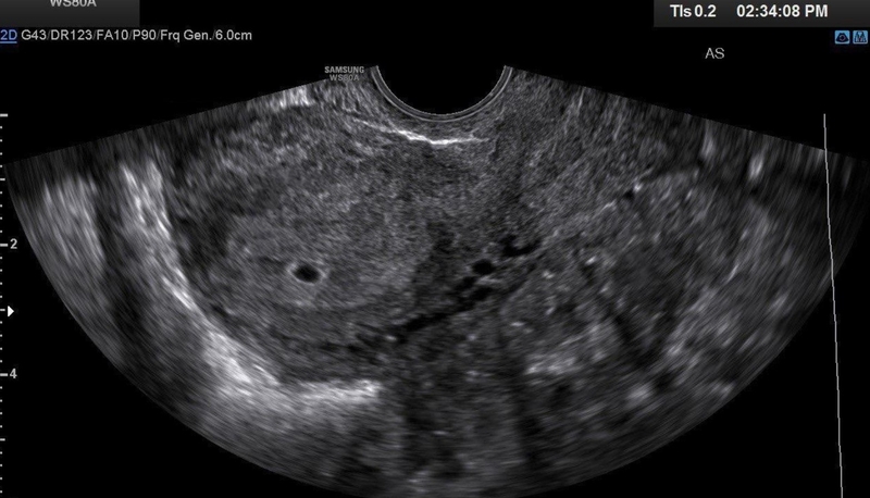 Túi thai 11mm chưa có phôi có sao không? Vì sao siêu âm thấy túi thai nhưng chưa có phôi? 3