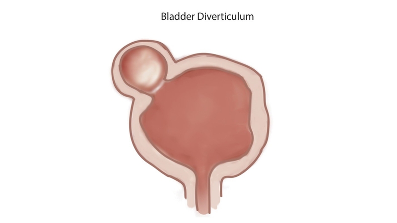 Túi thừa bàng quang là gì? Có nguy hiểm không? 1