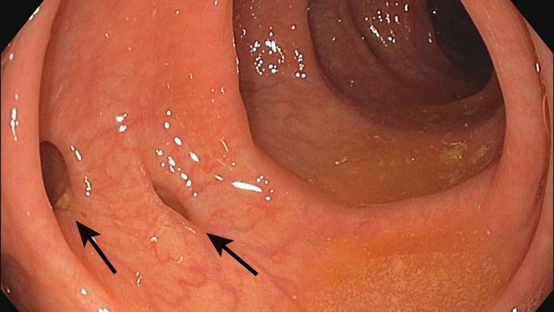 Túi thừa đại tràng: Nguyên nhân, triệu chứng và cách phòng ngừa 4