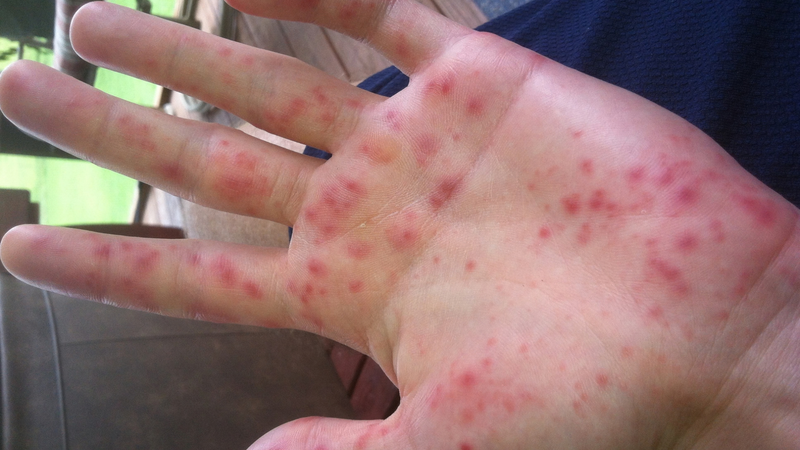 Trẻ vẫn có thể mắc tay chân miệng do các enterovirus khác