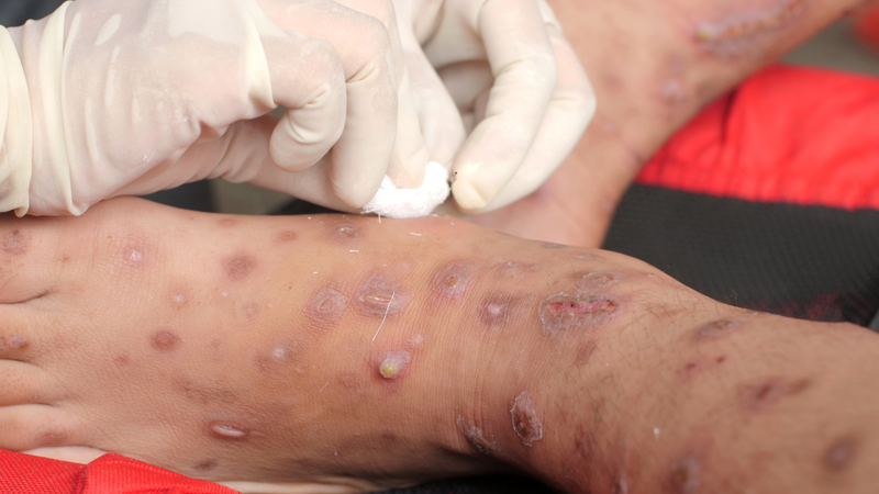 Các vị trí thường bị ảnh hưởng nhất của bệnh Tungiasis là bàn chân