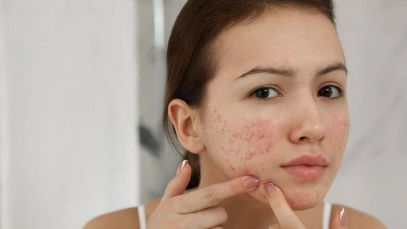 Mụn là một trong những vấn đề thường gặp với làn da khi bước vào độ tuổi dậy thì