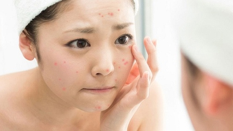 Tuổi dậy thì nên và không nên dùng sản phẩm chăm sóc da nào? 1