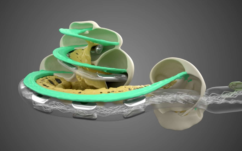 Tuổi thọ của ốc tai điện tử: Những yếu tố quyết định 3