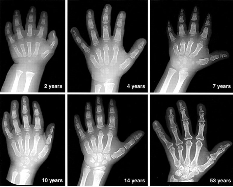 Tuổi xương là gì? Phương pháp để xác định tuổi xương như thế nào? 3