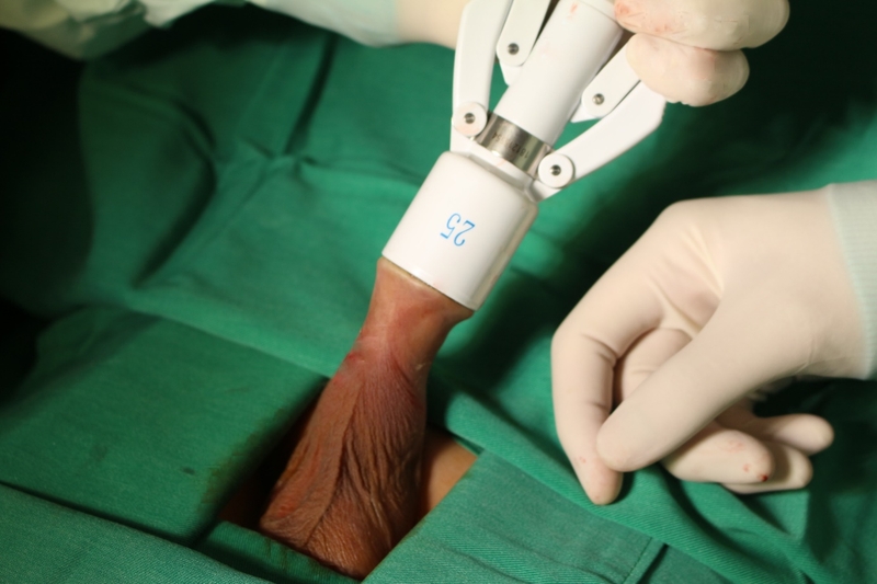 Tuột bao quy đầu bị sưng phồng là bị gì